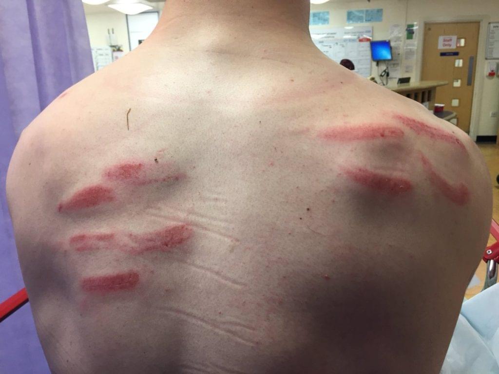 Lincoln Injury